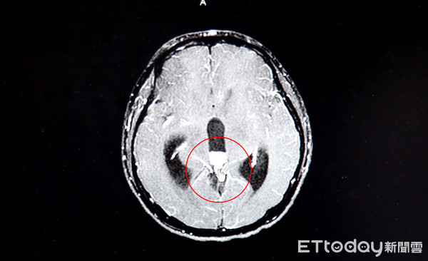 ▲男孩腦部的松果體部位長了1顆腫瘤（紅圈處），造成腦室內脊髓液無法順暢流出，而有腦壓升高的情況。（圖／記者黃孟珍攝）