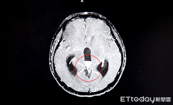 男孩腦部的松果體部位長了1顆腫瘤(紅圈處)々∞Ψˋ^ˊ↗○,造成