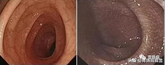 ▲左為正常腸粘膜，右為黑變病。（圖／翻攝自微博／胃腸病）