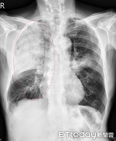▲▼亞大醫院胸腔外科主治醫師呂庭聿指出肺炎位置。（圖／亞洲大學附屬醫院提供）