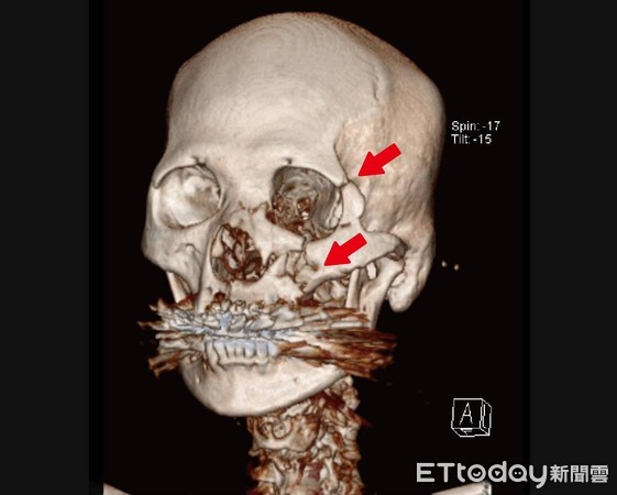 ▲個案經電腦斷層掃描後，箭頭處可見多處粉碎性骨折。（圖／馬偕醫院提供）