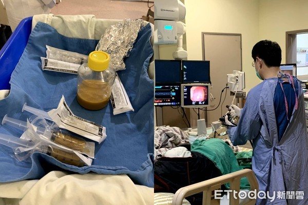 ▲長庚糞菌移植。（圖／長庚醫院提供）