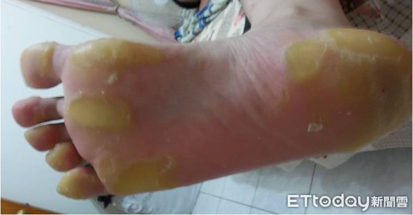 ▲▼ 角質層下膿疱性皮膚炎，患者常見腳底乾燥龜裂。（圖／大林慈濟醫院提供，下同）