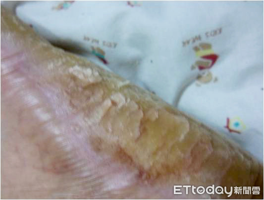 ▲▼ 角質層下膿疱性皮膚炎，患者常見腳底乾燥龜裂。（圖／大林慈濟醫院提供，下同）
