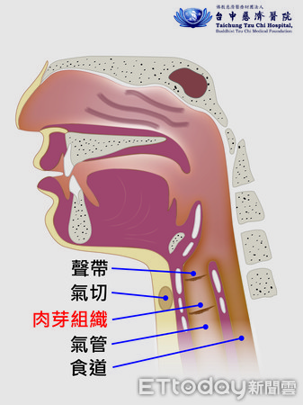 ▲▼臺中慈濟醫院胸腔內科邱國樑醫師表示，特殊體質的病人，臨床上遇到維持生命需要氣切時，必須以搶救生命為優先。支氣管內視鏡影像，左圖氣管因肉芽組織增生剩下一條細縫，右圖為電燒及冷凍方式去除肉芽組織將狹窄處打通。增生的肉芽組織位置示意圖。（圖／台中慈濟醫院提供）