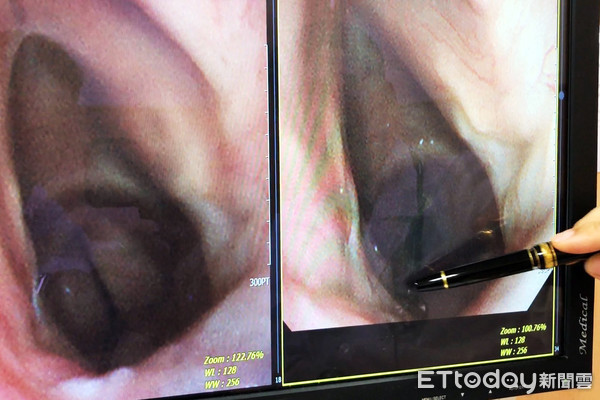 ▲▼臺中慈濟醫院胸腔內科邱國樑醫師表示，特殊體質的病人，臨床上遇到維持生命需要氣切時，必須以搶救生命為優先。支氣管內視鏡影像，左圖氣管因肉芽組織增生剩下一條細縫，右圖為電燒及冷凍方式去除肉芽組織將狹窄處打通。增生的肉芽組織位置示意圖。（圖／台中慈濟醫院提供）