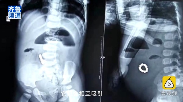 10顆磁力珠在肚內連成「手環」　1歲男童腸穿4孔腹痛就醫。（圖／翻攝自大陸梨視頻）