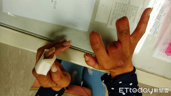 ▲▼截肢,抽菸,柏格氏症。（圖／門諾醫院提供）