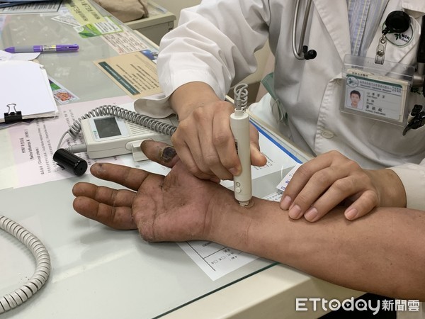 ▲▼截肢,抽菸,柏格氏症。（圖／門諾醫院提供）