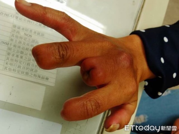 ▲▼柏格氏症發病初期外觀像是手腳凍傷，主要在手腳指末端有瘀青、發黑的現象，患者通常都不以為意，等到出現了腫脹、發紺才就醫。（圖／記者王兆麟翻攝，下同）
