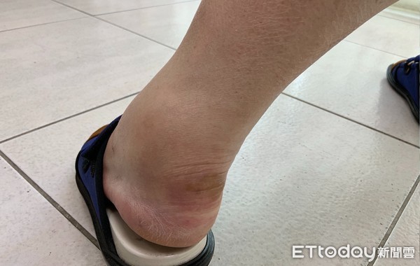▲▼因化療副作用手足產生紅腫、水泡。經中醫調理手足腫痛明顯改善。（圖／台南市立醫院提供）