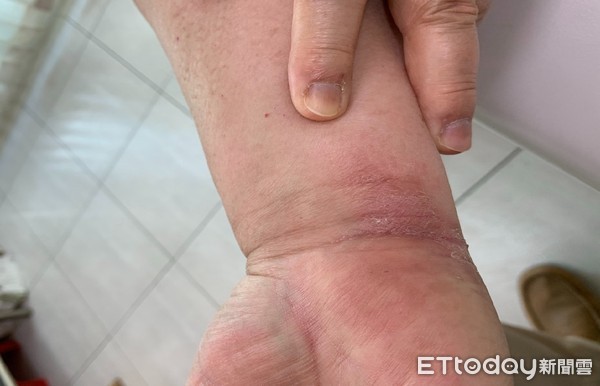 ▲▼因化療副作用手足產生紅腫、水泡。經中醫調理手足腫痛明顯改善。（圖／台南市立醫院提供）