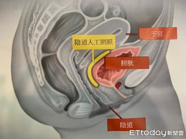 ▲陰道人工網膜風險。（圖／記者嚴云岑攝） 