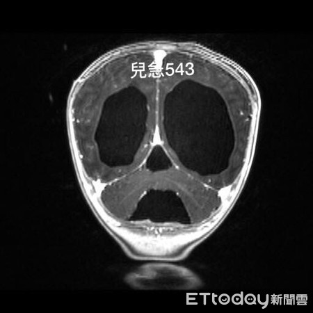 ▲水腦症。（圖／吳昌騰醫師提供）