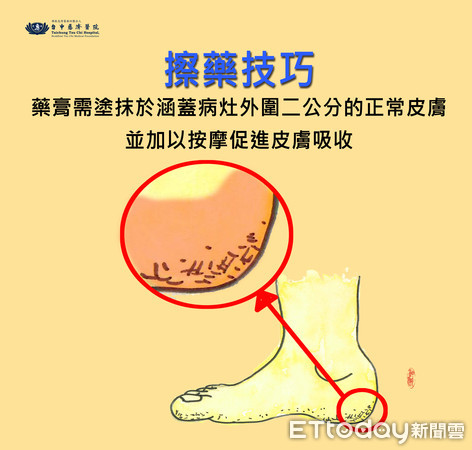 ▲▼香港腳,藥膏。（圖／台中慈濟醫院提供）