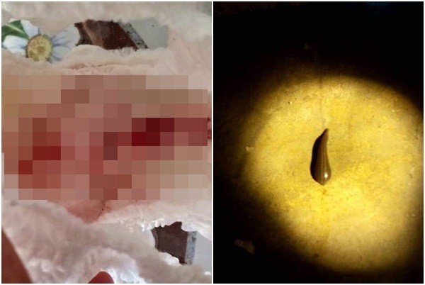 ▲▼泰國4歲女童下體遭水蛭鑽入吸血。（圖／翻攝自Facebook／Napaporn Thanawong）