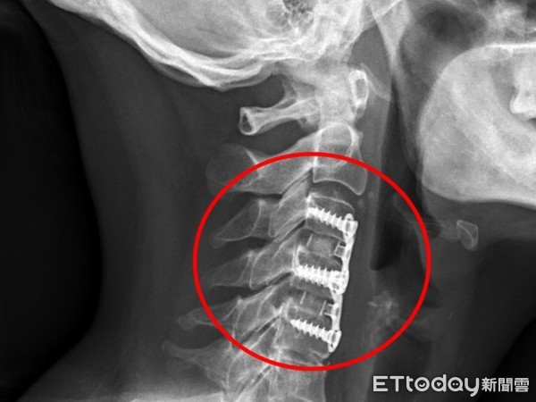 ▲楊小姐的頸椎第三節到第五節間的椎間盤軟骨已經破裂，壓迫到脊椎神經。（圖／慈濟醫學中心提供，下同）