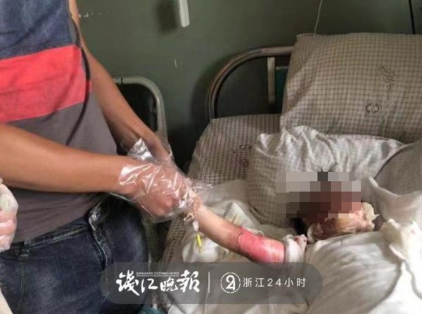 ▲掉進170度油鍋！爸媽心急幫脫衣...2歲女童「整片皮掉下來」狂哀號（圖／翻攝錢江晚報）