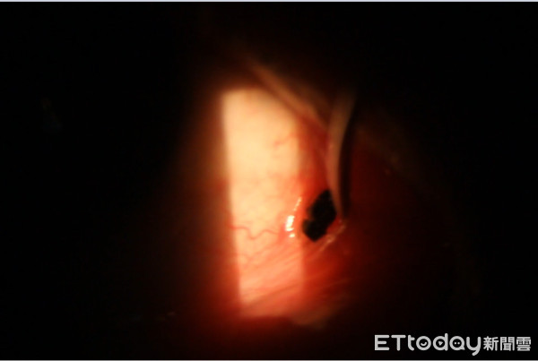 ▲▼眼結膜夾死蟲。（圖／陳加宇醫師提供）