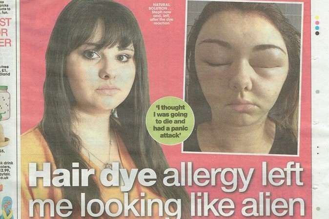 ▲▼染髮過敏讓她變成外星人。（圖／翻攝自臉書／HSpotMedia）