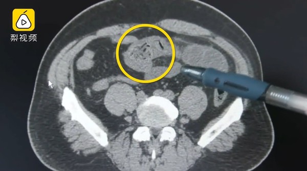 吃太快肚子突然爆痛！　醫生驚見「一顆完整蛋黃」卡他腸道一周。（圖／翻攝自大陸梨視頻）