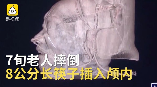 72歲老翁洗碗突然跌倒　筷子從眼球下方插入顱內8公分。（圖／翻攝自大陸梨視頻）