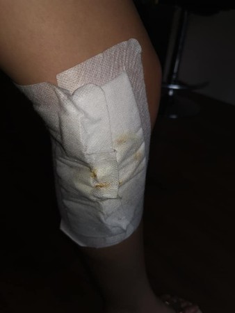 ▲▼英國11歲少女雙腿遭美甲膠嚴重灼傷。（圖／翻攝自FB／Louise Worsfold）