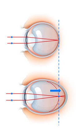 ▲▼過度使用3C產品，會導致眼軸增長太快，使得影像無法投射到視網膜上，上圖為正常。（圖／高雄亮晶晶眼科診所提供）