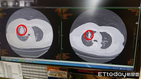 ▲▼早餐娘肺腺癌。（圖／長安醫院提供）