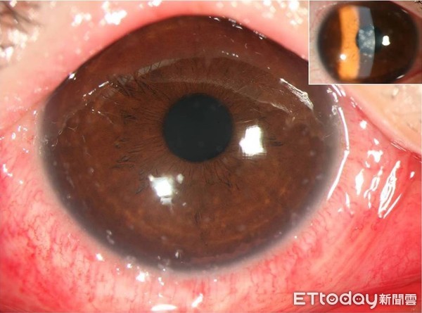 ▲病毒性結膜炎。（圖／陳宏吉醫師提供）