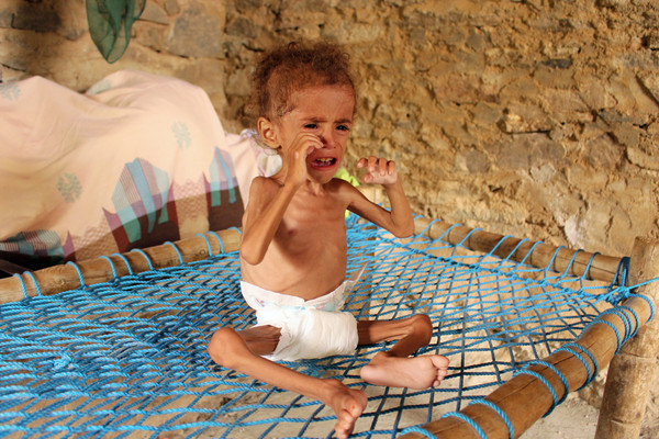 ▲▼葉門內戰導致孩子瘦成皮包骨。（圖／路透）