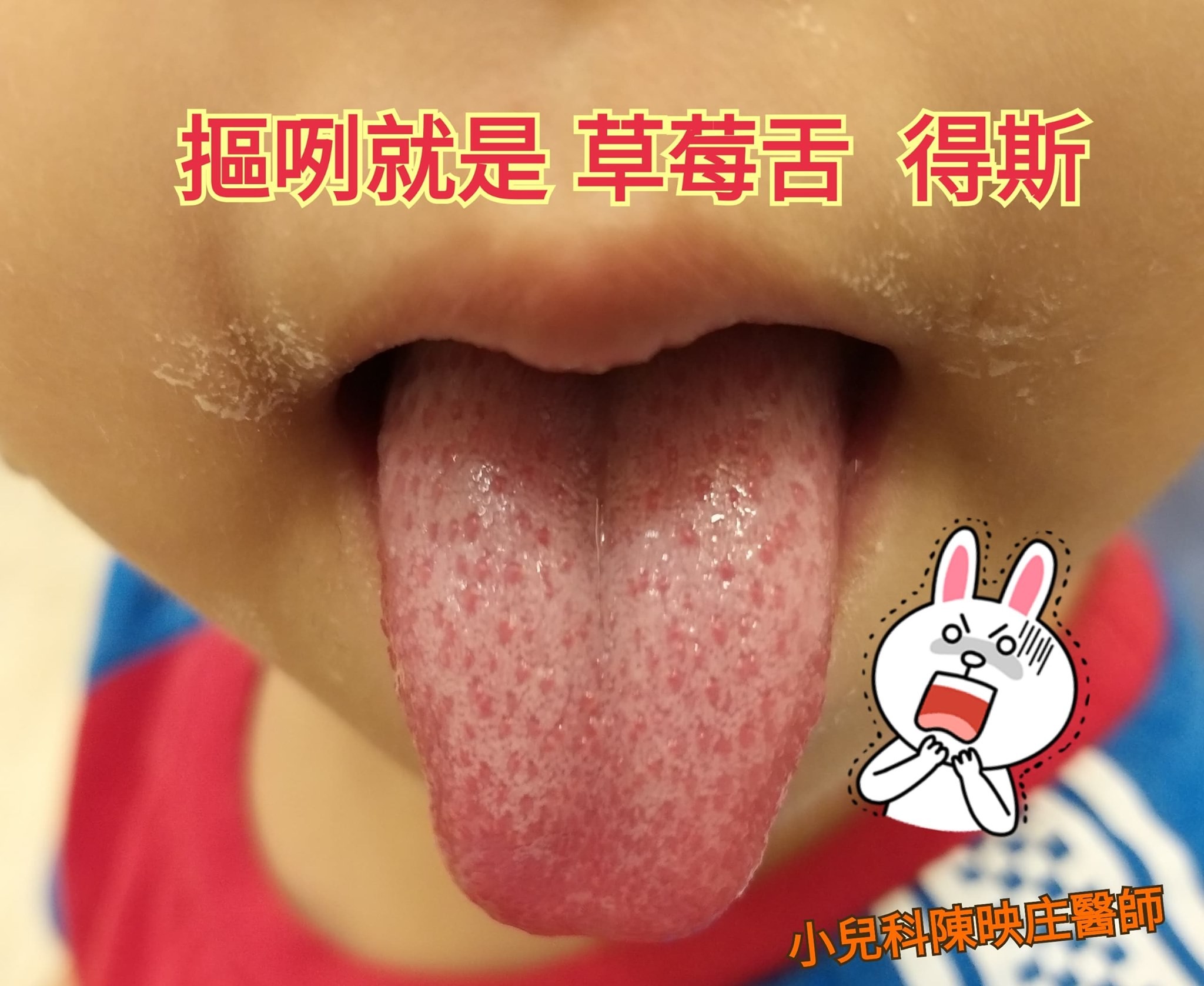 图文并茂，看懂儿童舌苔！_治疗