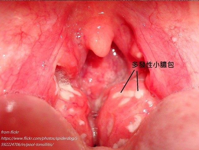 3童快篩全中「腺病毒」！扁桃腺全是白膿包醫曝7大警告 ETtoday健康 