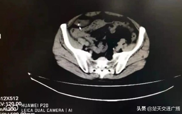 聽信偏方豪買10條「活跳跳泥鰍」　整條生吞下肚害他腸穿孔化膿。（圖／翻攝自大陸《楚天交通廣播》）