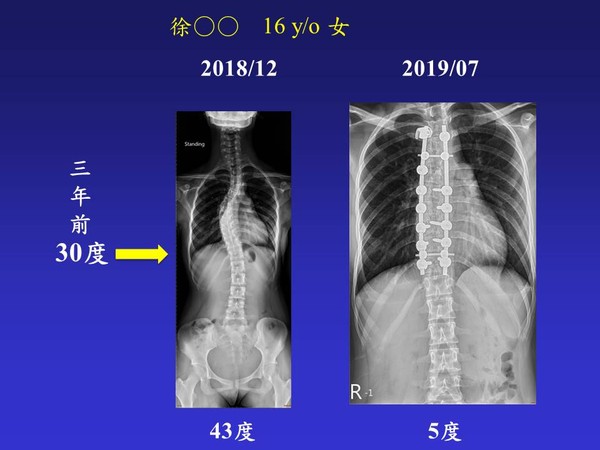 ▲▼脊椎側彎個案術前術後。（圖／北醫附醫提供）