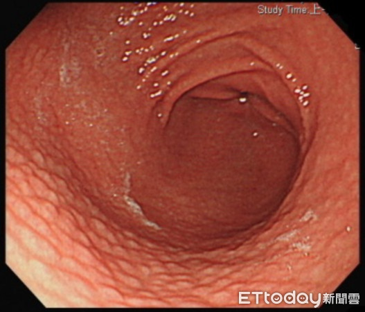 ▲貧血又腹脹竟是「致癌菌」惹禍　他胃表皮長疙瘩如「炸雞皮」。（圖／書田診所提供）
