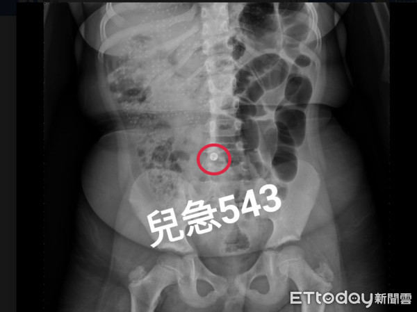 ▲鐵珠卡肚臍。（圖／吳昌騰醫師提供）