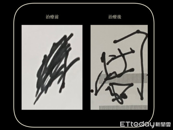 ▲簽名手抖被當賊　神波刀讓他從狂草變正楷。（圖／中國附醫提供）