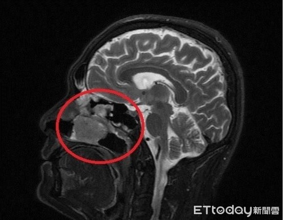 ▲南投曾姓男子以為自己只是因過敏而鼻塞，到南投醫院就診後發現鼻腔內塞滿惡性腫瘤。（圖／南投醫院提供）