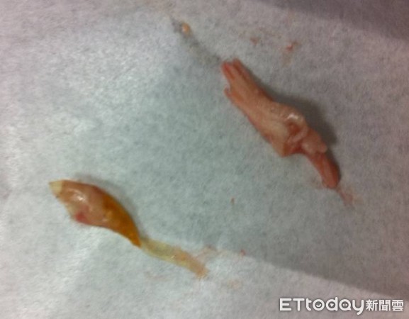 ▲中毒？8歲童「咬一口雞肉串」嘔吐昏迷　醫找出真相家長全傻眼。（圖／吳昌騰醫師提供）