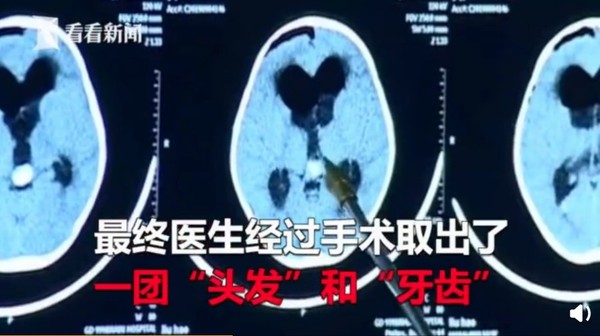 5歲童手抖半年湯匙都拿不穩　開腦取出「一團頭髮和牙齒」。（圖／翻攝自大陸微博／看看新聞在現場）