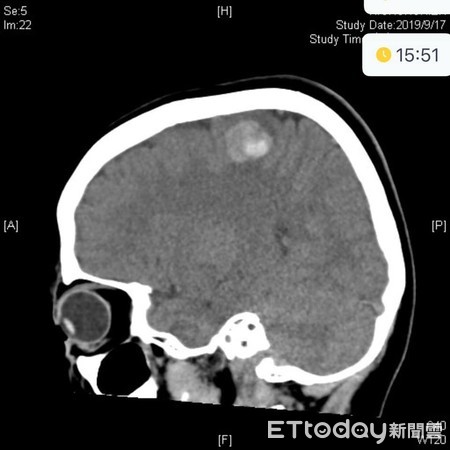 ▲兒童腦中風。（圖／吳昌騰醫師提供）