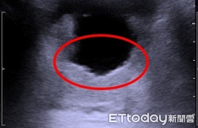 ▲▼攝護腺肥大。（圖／亞大醫院提供）