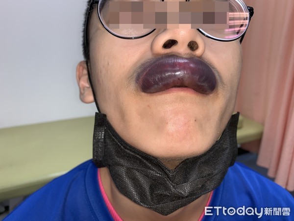 ▲▼香腸嘴。（圖／賴昕隄醫師提供）