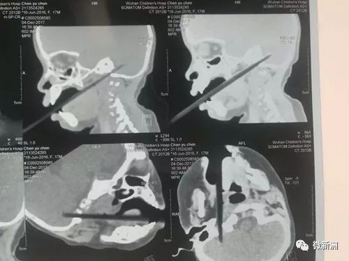 ▲邊吃邊玩！1歲半女童嘴含筷子突跌倒...下秒整根「直插腦後」。（圖／翻攝微信）