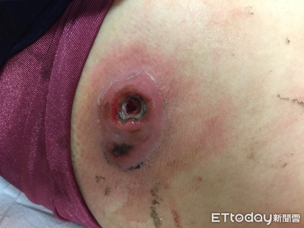 ▲▼傷口,青春痘,癰,痘痘。（圖／亞洲大學附設醫院提供）