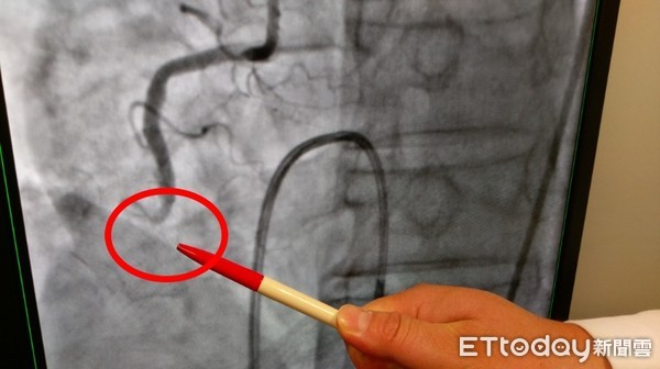 ▲▼圖說1-2：長安醫院心臟血管科陳士仁醫師表示，陳先生經檢查是下壁急性心肌梗塞圖說2：陳先生爬山時發生急性心肌梗塞，幸好緊急送醫接受心導管治療。copy OK圖說1-1：長安醫院心臟血管科陳士仁醫師表示，陳先生經檢查是下壁急性心肌梗塞，緊急。（圖／長安醫院提供）