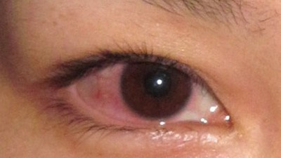空汙嚴重「結膜炎」紅眼人大增！肥皂清潔眼瞼　有效降低感染率