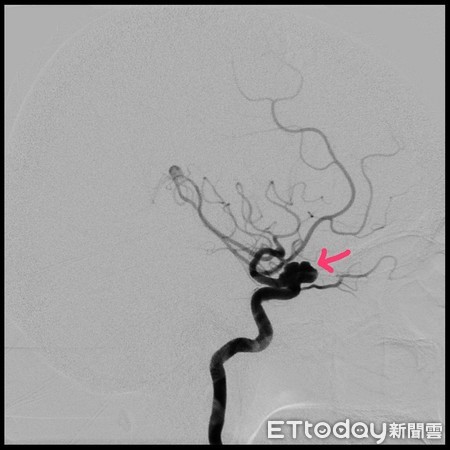 ▲腦動脈瘤高風險族群，一定要定期磁振造影檢查追蹤腦動脈瘤大小，以作醫療處置。（圖／記者林悅翻攝，下同）