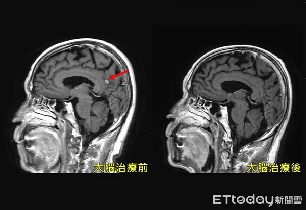 頭暈 走路歪斜 竟是肺癌末期 1cm腫瘤早轉移腦 肝 Ettoday健康雲 Ettoday新聞雲